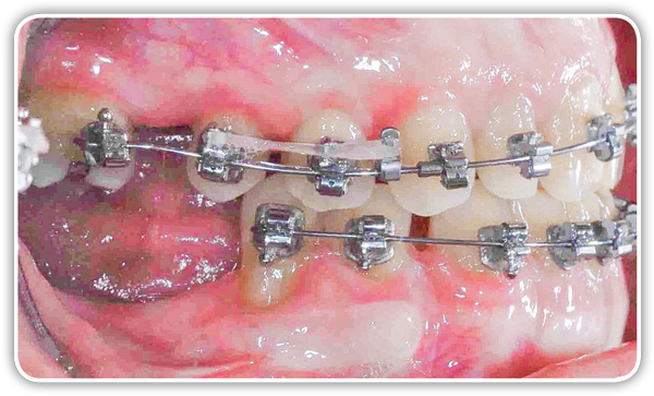 SPEED System Orthodontics